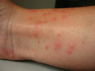 Reactie van brandharen op de huid